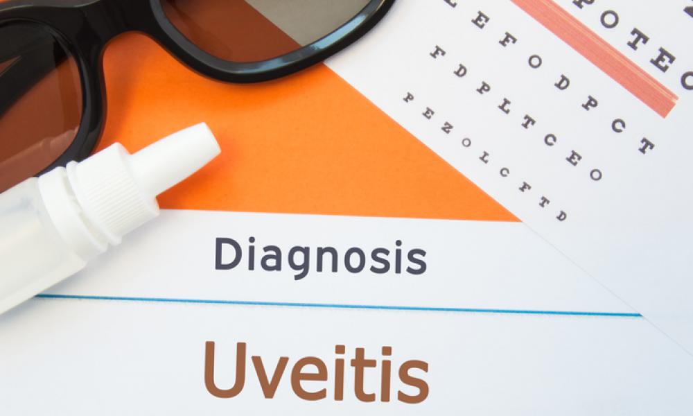 Uveitis