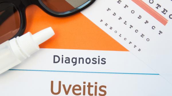 Uveitis